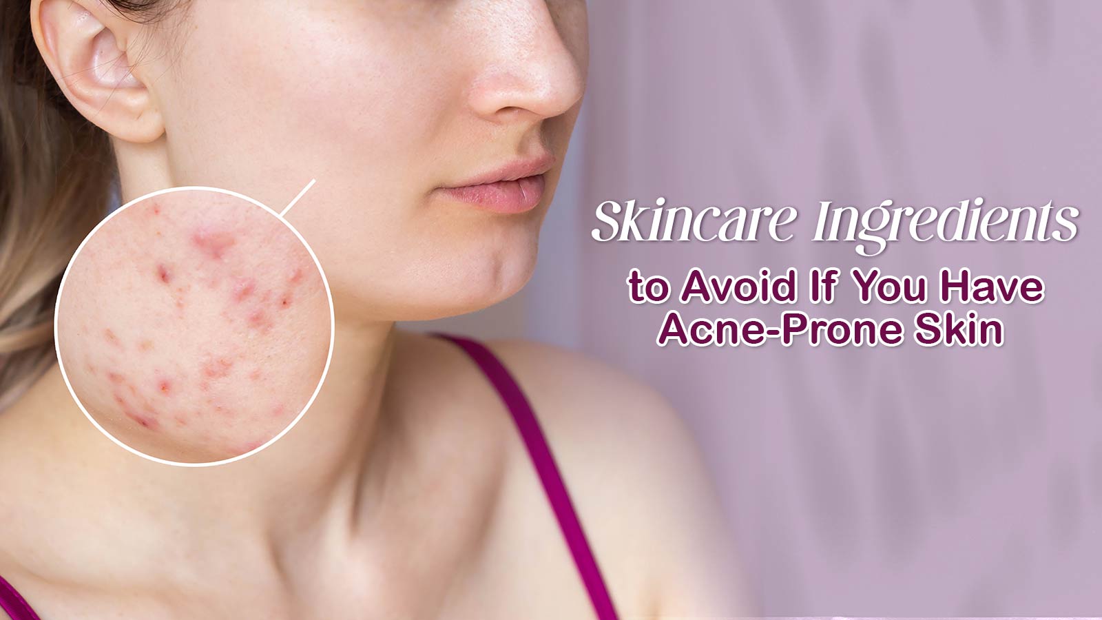 Skincare Ingredients to Avoid If You Have Acne-Prone Skin